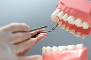 Implantes dentales Torrelavega